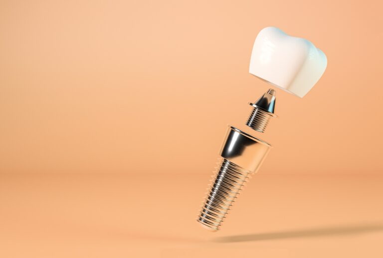 Errori implantologia dentale