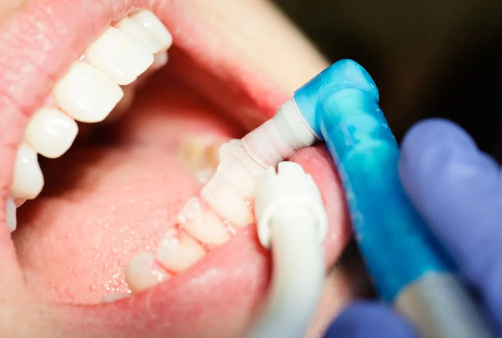 Pulizia Dentale Professionale Pulizia Dentale Professionale